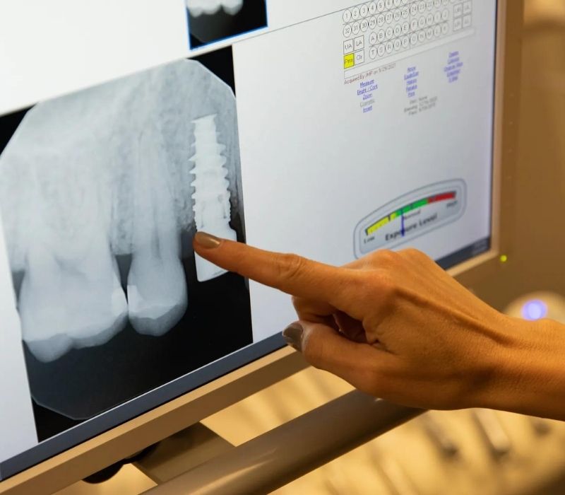 Implant Dentistry