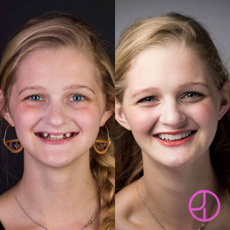 Before and After Dental Treatment at Expertise Dental Charleston