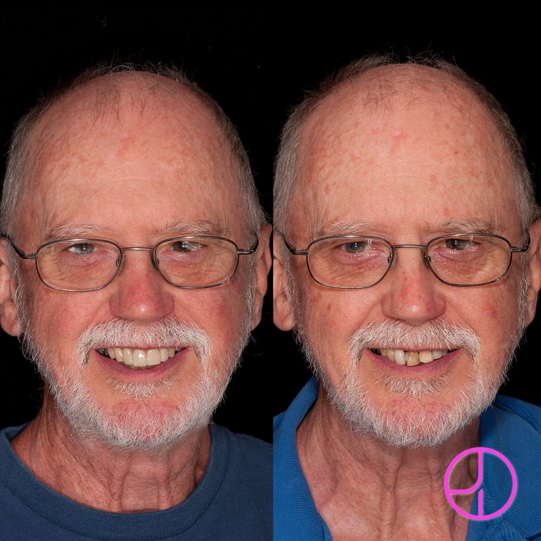 Before and After Dental Treatment at Expertise Dental Charleston