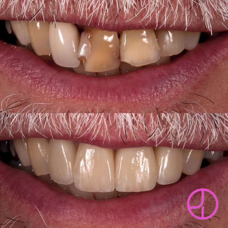Before and After Dental Treatment at Expertise Dental Charleston