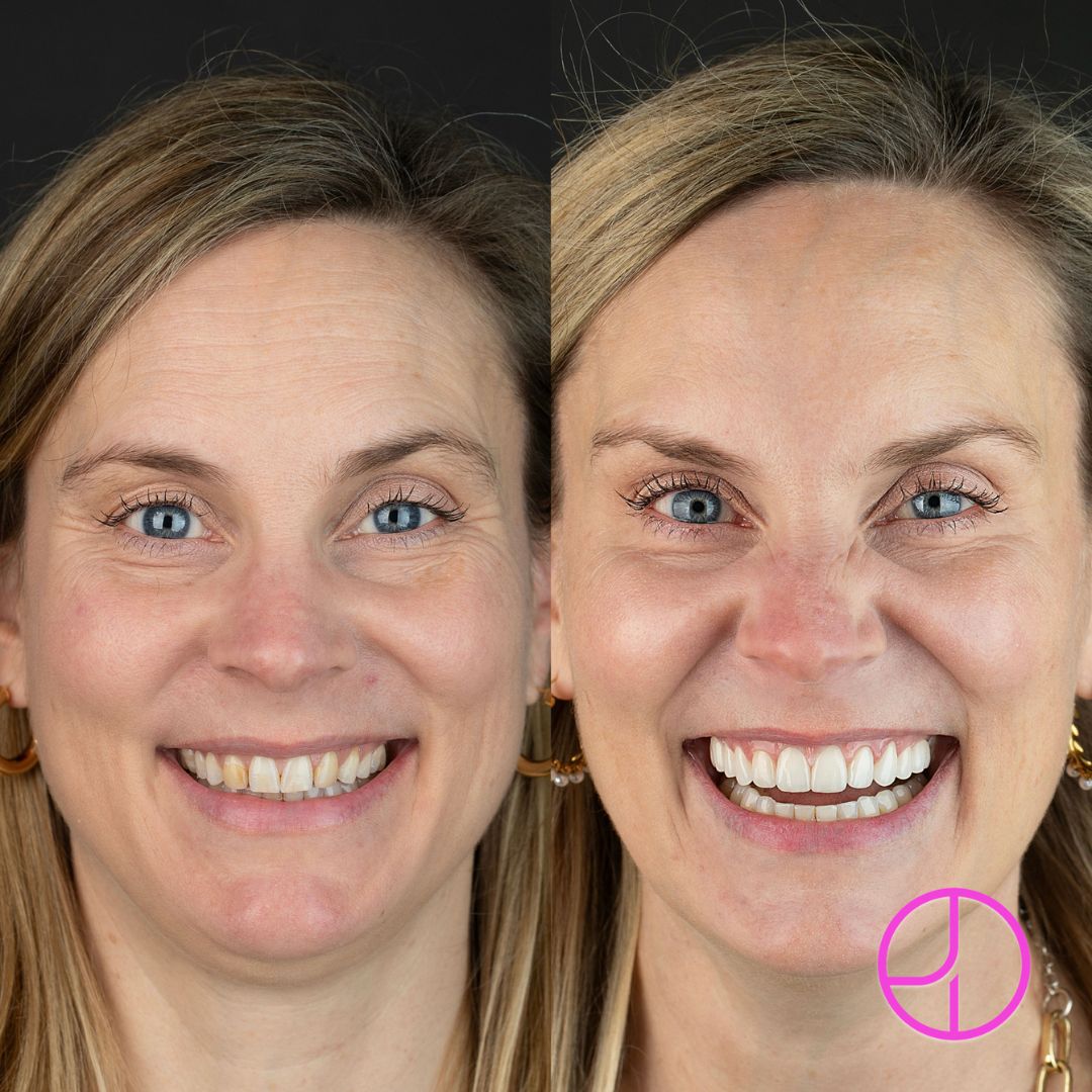 Before & After photo of veneers treatment at Expertise Dental, Mount Pleasant