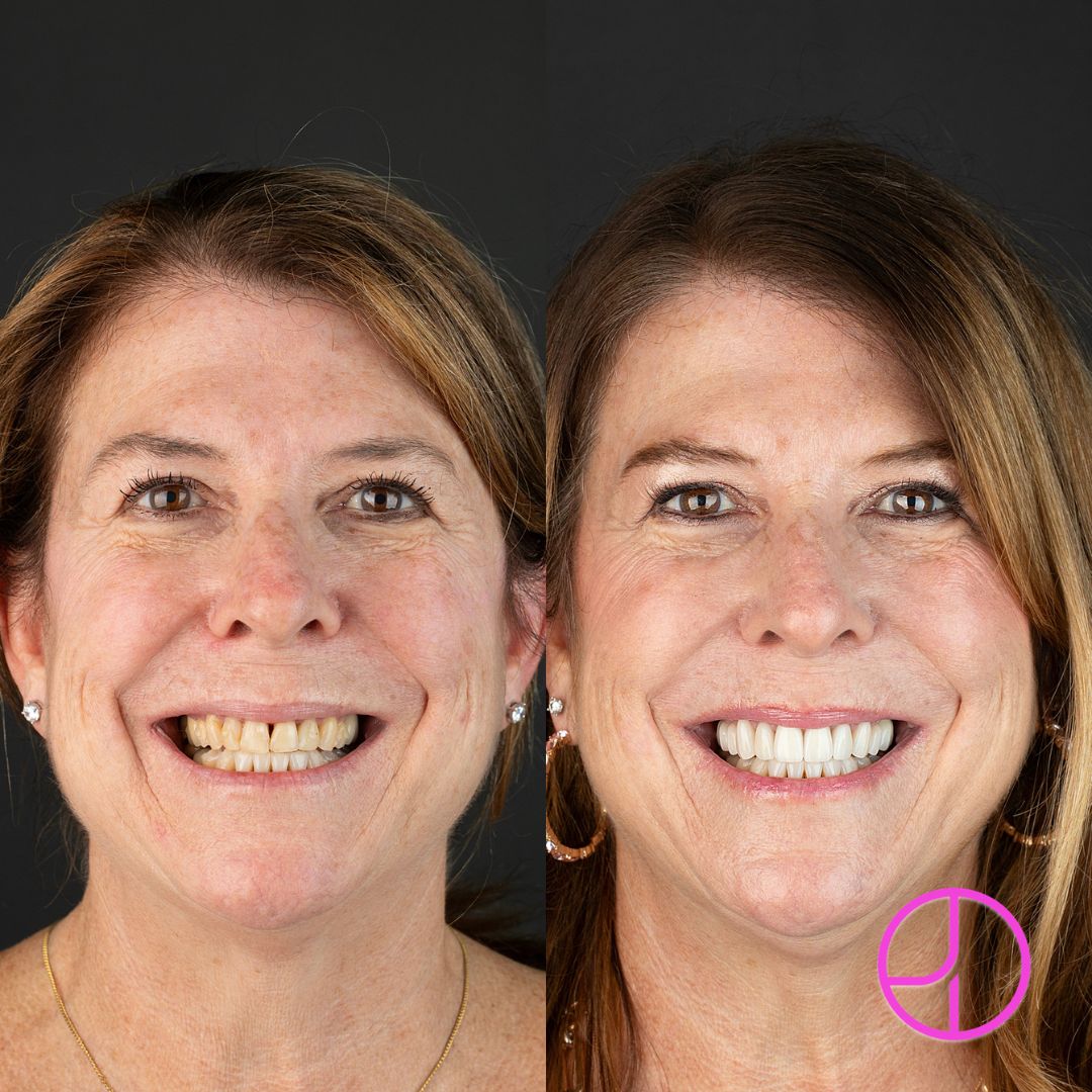 Before & After photo of smile makeover treatment at Expertise Dental, Mount Pleasant