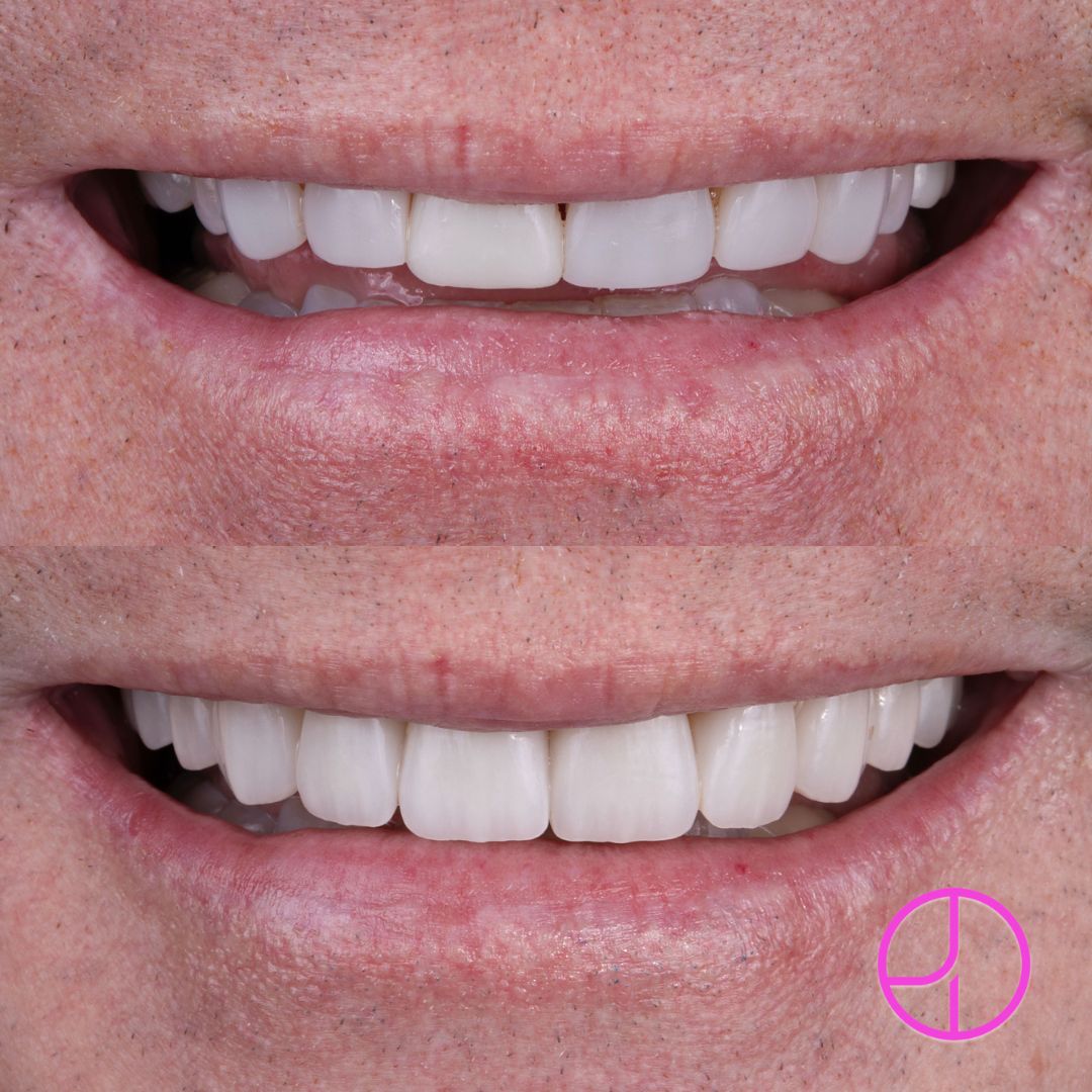 Before & After photo of smile makeover treatment at Expertise Dental, Mount Pleasant