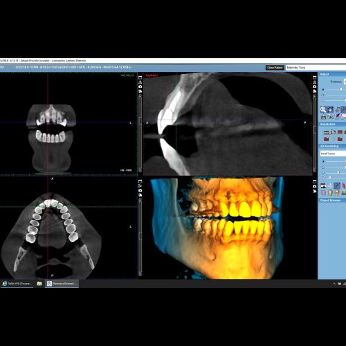 CBCT Scan
