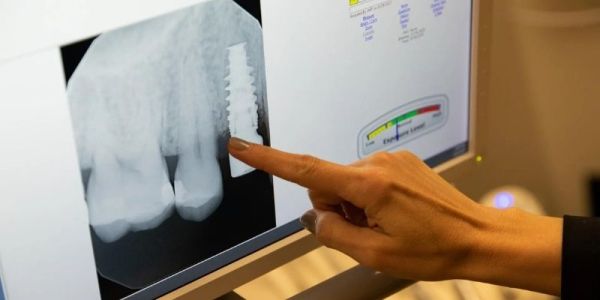 Expertise Dental Charleston Implants